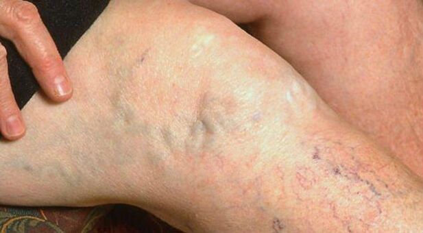 Pastebimi kojų venų varikozės simptomai